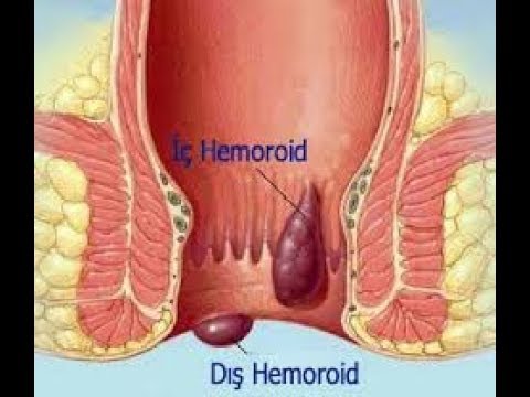 İnternal Hemoroidlerin Sınıflandırılması